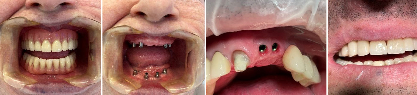 Protetyka stomatologiczna przed i po