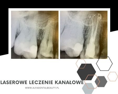 laserowe leczenie kanalowe