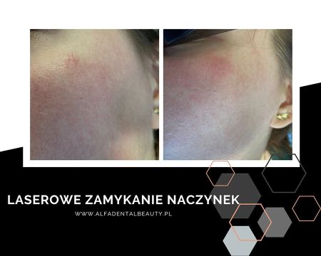 laserowe usuwanie naczyniakow  