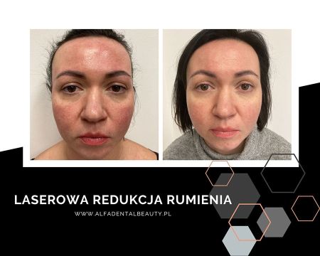 laserowe usuwanie naczyniakow  
