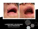 laserowe usuwanie naczyniakow