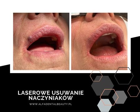 laserowe usuwanie naczyniakow