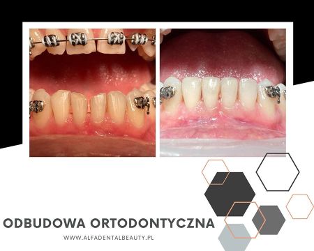 odbudowa ortodontyczna