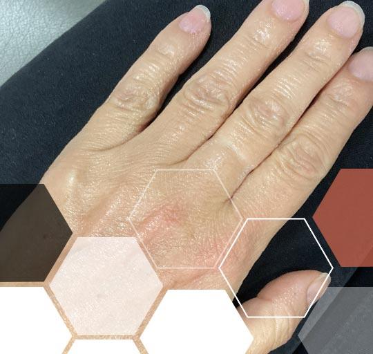 Zabiegi na dłonie Kraków