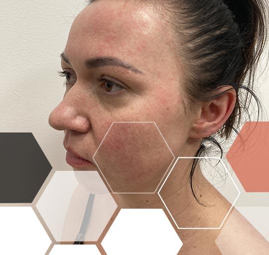 Redukcja rumienia Kraków