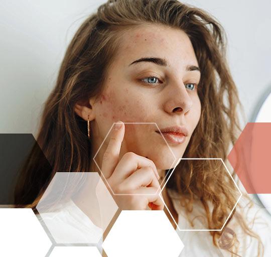 Leczenie trądziku Kraków