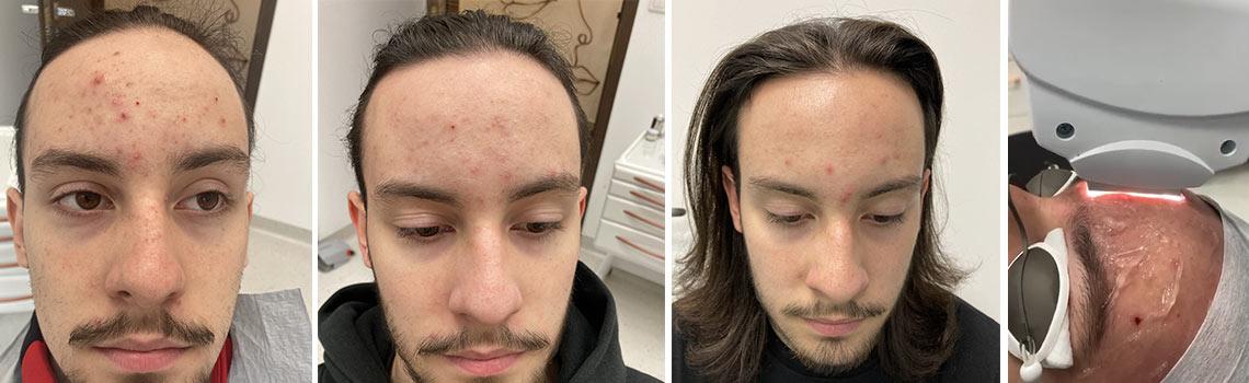 Laserowe leczenie trądziku - widoczne efekty przed i po zabiegu