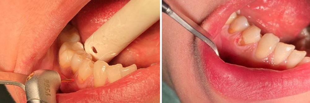 Stomatologia zachowawcza Kraków efekt zabiegu przed i po