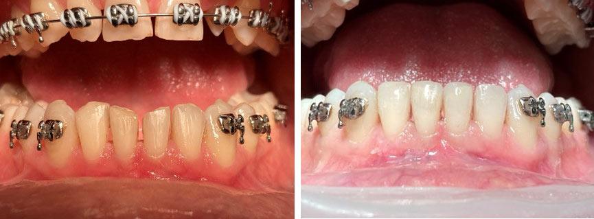 Ortodoncja Kraków - zobacz efekty